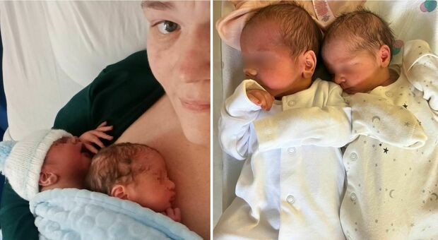 Mamma partorisce due gemellini nello stesso momento, il caso rarissimo. L'ospedale: «Mai visto nulla di simile»