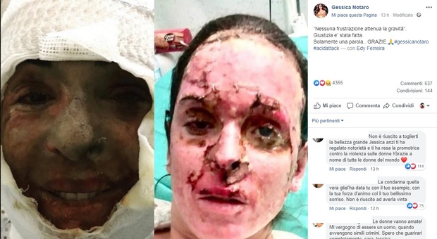Gessica Notaro: «Giustizia è stata fatta» E pubblica le foto col volto sfigurato