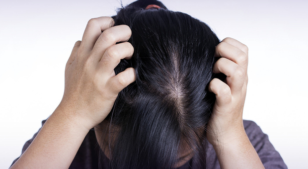 Perdita di capelli, possibile cura grazie al "gene dell'uomo delle caverne": riattivarlo può sconfiggere la calvizia