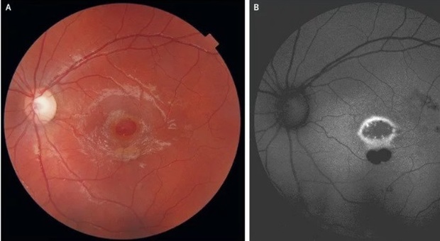 Bambino di 9 anni con un buco nella retina: colpa del laser puntato negli occhi