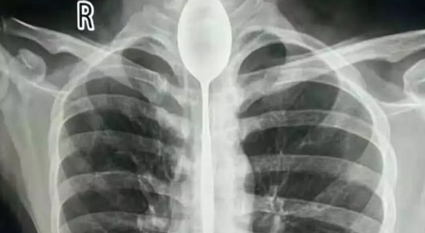 Ha forti dolori al petto, radiografia svela un cucchiaio ingoiato un anno prima