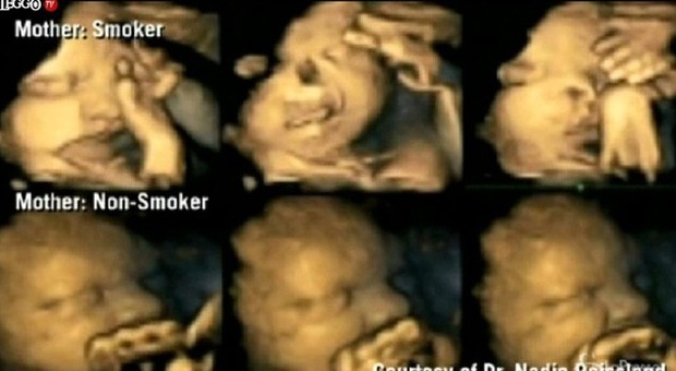 Se conoscete una donna che fuma in gravidanza, fatele vedere queste foto