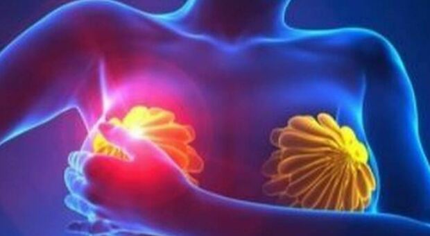 Tumore al seno, individuato gene che ne indica la predisposizione: lo studio dell'Università di Padova