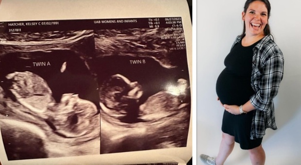 Mamma nata con due uteri rimasta incinta in entrambi contemporaneamente: ora aspetta due gemelle. Il caso rarissimo