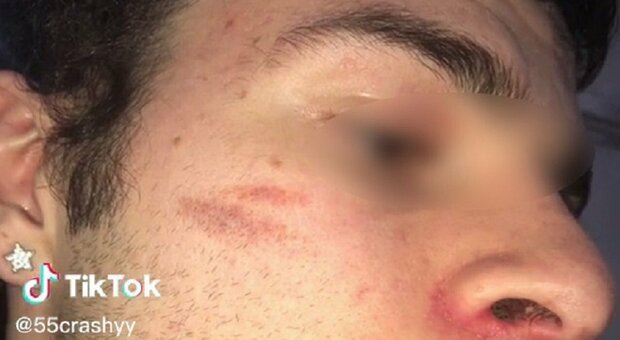 Cicatrice francese: uno sfregio sul volto per una challenge su Tiktok. È allarme anche in Puglia