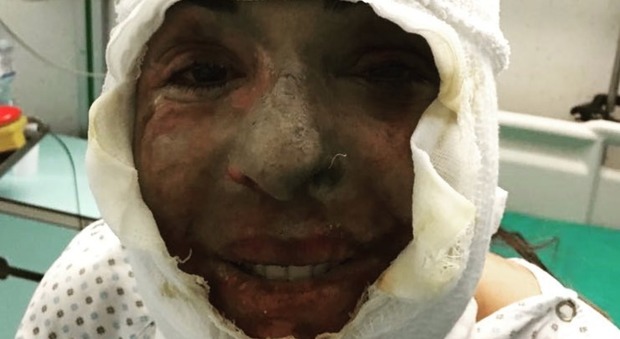 Gessica Notaro, la prima foto dopo l'aggressione con l'acido: "Sono riuscita a sorridere lo stesso"