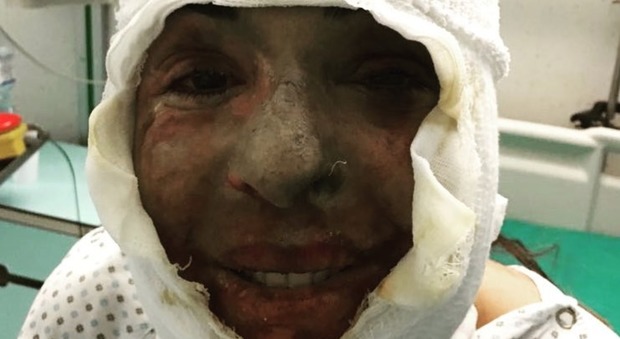 Gessica Notaro, la prima foto dopo l'aggressione con l'acido: "Sono riuscita a sorridere lo stesso"