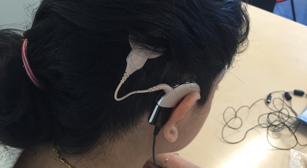 L'orecchio bionico attivato sulla ragazza di 22 anni