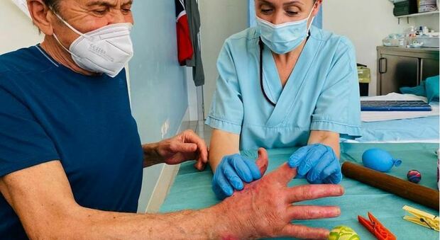 Gianni Morandi inizia la fisioterapia dopo l'ustione alle mani