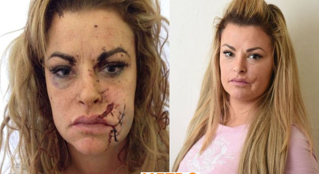Gemma, 34 anni, aggredita e sfregiata in volto da una sconosciuta
