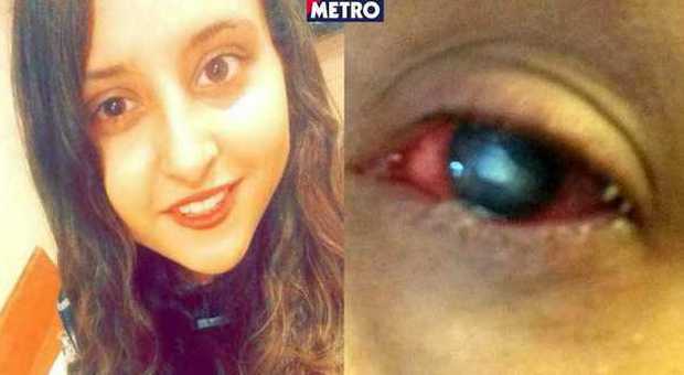 Jessica Greaney e il suo occhio (Metro)Acanthamoeba