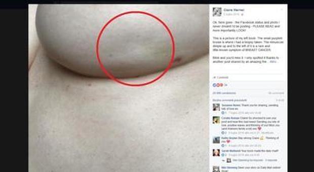 Cancro al seno, nel post virale su Facebook c'è un sintomo sconosciuto ai più | Guarda
