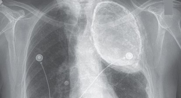 Ha dei problemi a respirare, i medici scoprono che da 60 anni ha olio nei polmoni: ecco perché