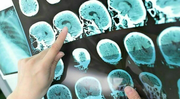 Influenza, ricerca trova un legame con malattie neurogenerative: «Rischio elevato di avere Alzheimer o Parkinson»