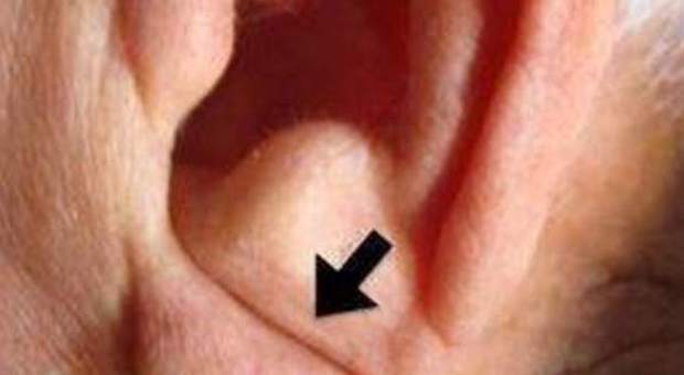 Una piega diagonale sul lobo dell'orecchio può indicare rischio di infarti e ictus