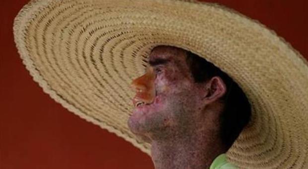 Araras, il villaggio brasiliano che soffre di xeroderma pigmentoso: la pelle si scioglie al sole (Ap)