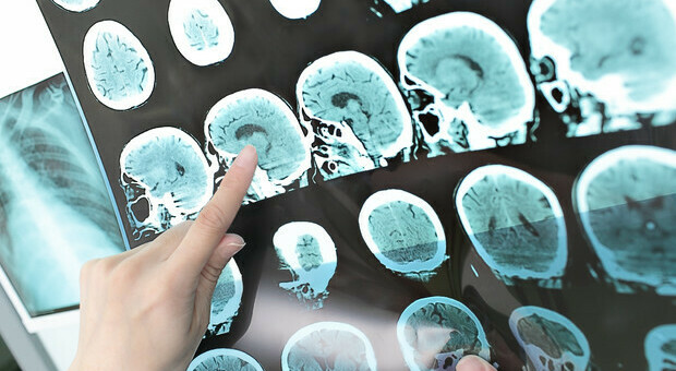 Ictus cerebrale ischemico: la cura con l'intelligenza artificiale