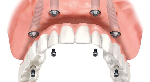 Etica Dentale presenta l'implantologia flapless: come inserire un impianto senza lasciare ferite e senza punti di sutura