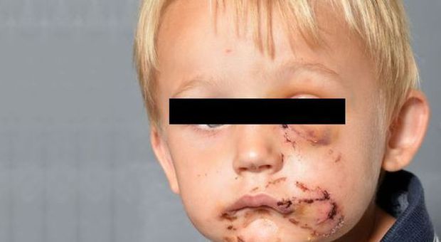 Azzannato dal pitbull dei vicini, bimbo di 4 anni sfigurato