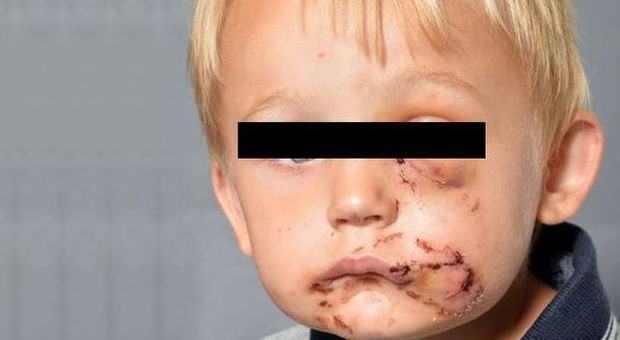 Bimbo di 4 anni assalito da pitbull, ferito gravemente