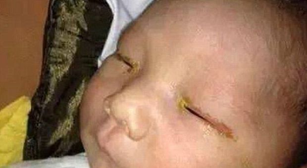 Scattano una foto ad un bimbo di tre mesi: il flash troppo vicino lo rende cieco