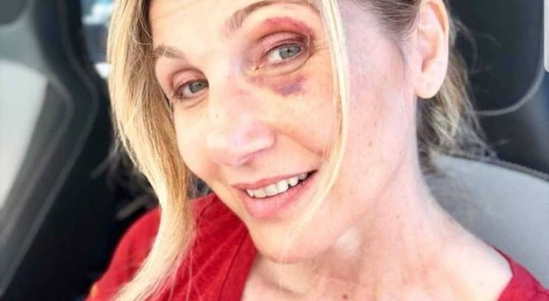 Lorella Cuccarini, foto dell'incidente sui social: «Sono caduta per colpa di una buca»