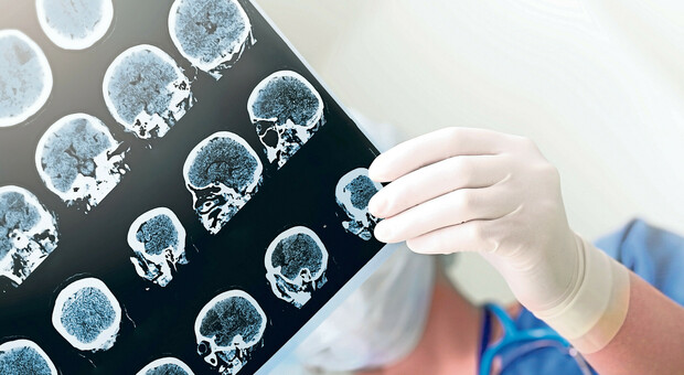 Cervello, proteine chiave per nuove armi anti-Alzheimer