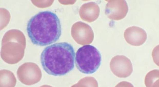 Neoplasie del sangue: ecco i farmaci che favoriscono la morte delle cellule tumorali