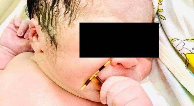 Neonato viene al mondo stringendo nella mano l'anticoncezionale: la foto fa il giro del mondo
