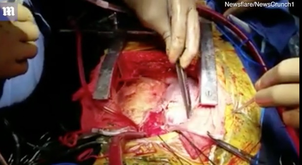 Il cuore donato è troppo piccolo, il chirurgo compie un intervento incredibile: ora il paziente ne ha due