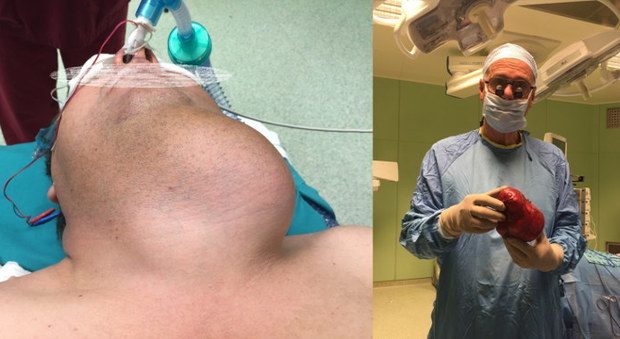 Intervento eccezionale all'Angelo: asportata tiroide di quasi un chilo