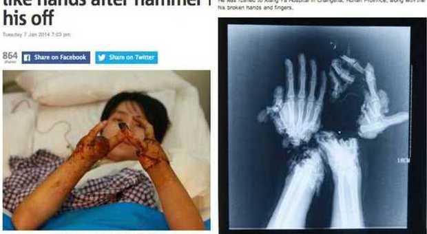 Wang Jin, 18 anni, perde le mani e gli riattaccano 4 dita (Metro.uk)