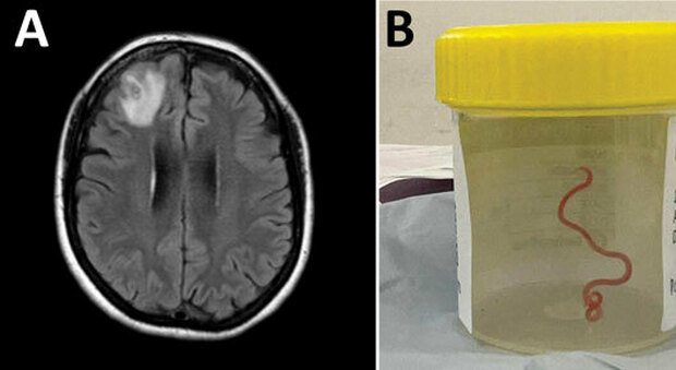 Larva viva dentro al cervello, paziente di 64 anni salvata a Canberra: primo caso al mondo