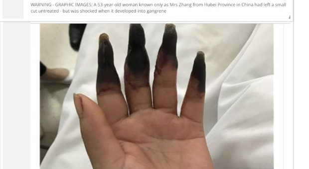 Si ferisce mentre fa le pulizie in casa, poi la sorpresa choc: «Le sue mani sono diventate nere»