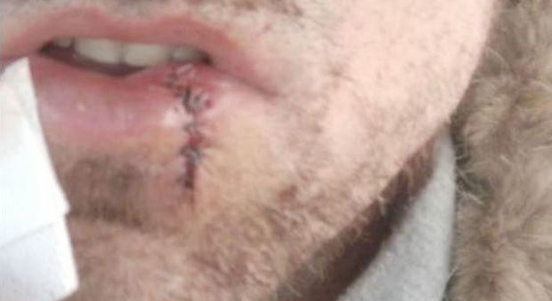 La bocca del 35enne dopo l’intervento dei medici del Ca’ Foncello che gli hanno ricucito la ferita al labbro