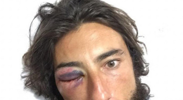 Brumotti operato all'occhio dopo l'aggressione: "Tornerò in sella alla mia bici sopra le ringhiere"