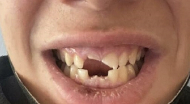 Denti spaccati