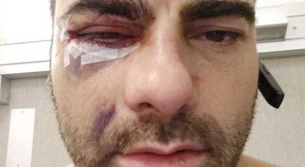 Massimiliano Idolo, il barman picchiato: «Io con il volto rovinato, e quei due pugili liberi»