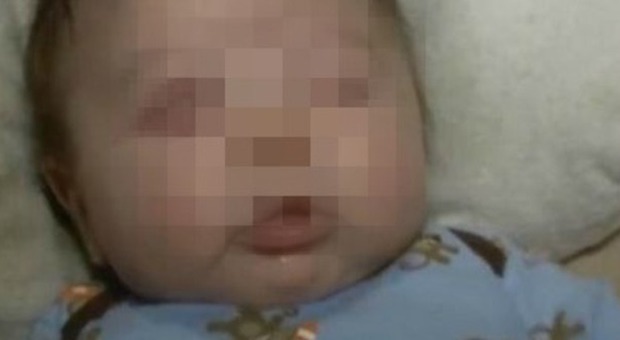 Il bimbo nato senza occhi: colpa di una malformazione nel grembo della mamma