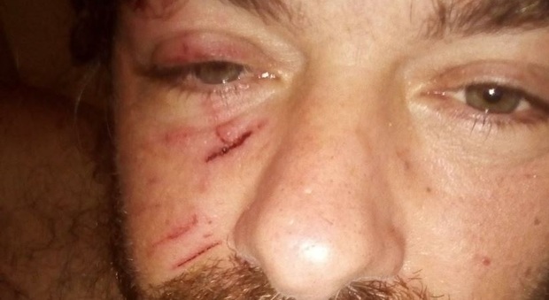 Ex consigliere ferito da babygang: «Ho rischiato di perdere un occhio»