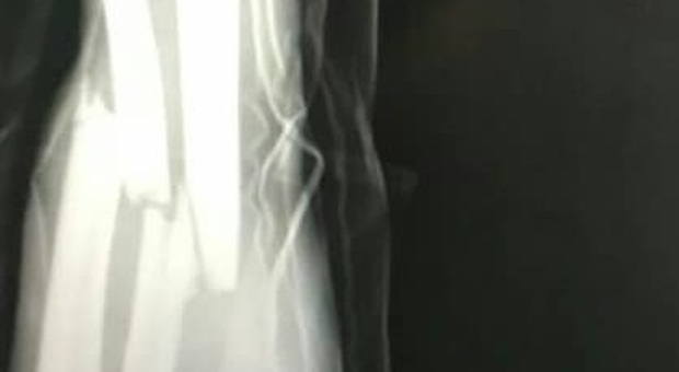 La radiografia evidenza la brutta frattura