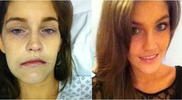 Stefanie prima e dopo l'intervento