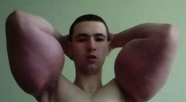 "Voglio essere come Braccio di Ferro", ex soldato russo si inietta oli pericolosi per vincere gare di bodybuilding