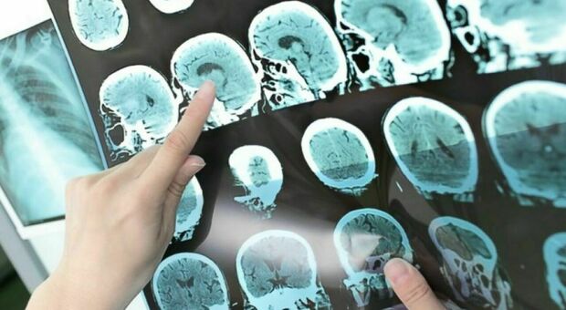 Test dei soldi rivelatore dell'Alzheimer, studio avviato nei supermercati: «È la spia del decadimento neurologico». Come funziona