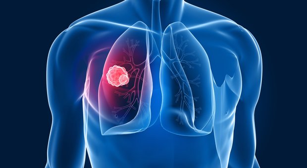 Polmone, nuova arma contro il cancro: più efficace della chemio
