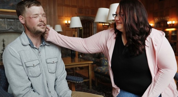 Usa, dopo un tentato suicidio riceve un trapianto facciale, un anno dopo incontra la moglie del donatore