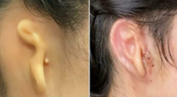 un'immagine dell'orecchio prima e dopo il trapianto