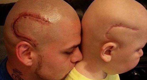 Usa, padre si fa tatuare cicatrice in testa per assomigliare al figlio operato al cervello