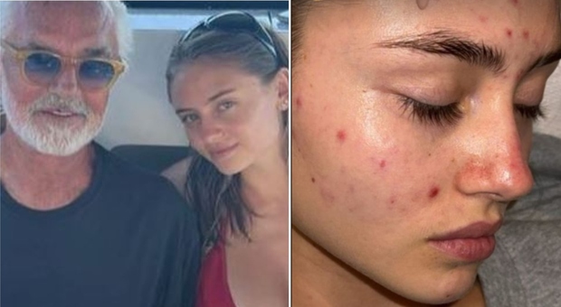 Briatore, la figlia Leni Klum senza filtri sui social: la foto col viso pieno d'acne