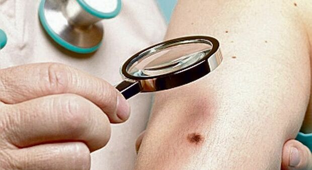 Nel Bellunese stanno aumentando i casi di melanoma
